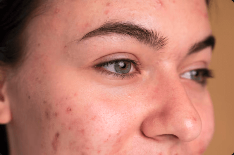 Descubra a conexão entre Hormônios e Beleza da Pele. Entenda o impacto hormonal e encontre soluções naturais e conscientes na Slow Beauty.